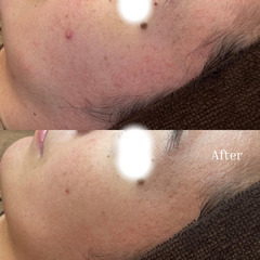 2回目でここまで変化！那覇のハーブピーリング症例