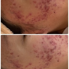 ニキビ・ニキビ跡のお悩み解消✨️