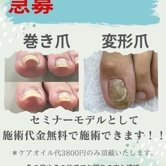 11/27 11/28 巻き爪モデルさん　変形爪(浅草橋)