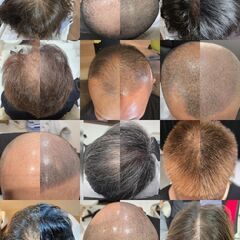 【薄毛隠し】頭皮タトゥー専門サロン「add365」