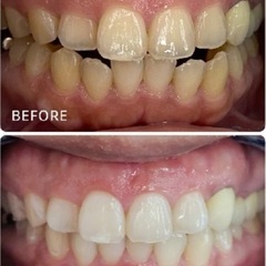 ホワイトニング施術🦷✨3名様限定‼️1年間通い放題🔥1回あたり60円😳😳今後販売はありません！※販売期間あり⚠️の画像