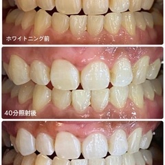 ホワイトニング施術🦷✨3名様限定‼️1年間通い放題🔥1回あたり60円😳😳今後販売はありません！※販売期間あり⚠️の画像