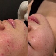 【南堀江】毛穴洗浄を試してみたい方へ✨お肌ケアのご案内（男女OK）の画像