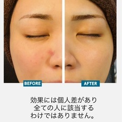 冬の乾燥！肌のお悩み！解消😊✨12月はキャンペーン中✨