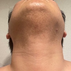 ❄️冬の脱毛キャンペーン❄️の画像