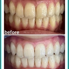 12/13(土)限定‼️残り1名様💦ホワイトニング施術🦷✨半年間通い放題(最低保証付き)😳😳の画像