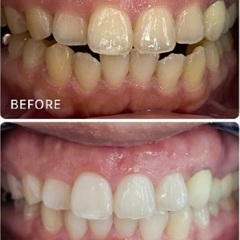 ホワイトニング施術🦷✨数量限定💦1年間通い放題😳😳最低保証の回数は有効期限なし‼️12月で受付終了💦の画像