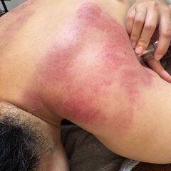 【１DAY講座】リラクゼーションカッピングセラピスト講座の画像