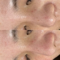 【剥離なしハーブピーリング＋毛穴吸引｜那覇市松川】