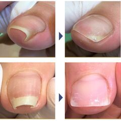 巻き爪矯正・変形爪補正の施術の練習モデルを探しています！