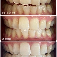 キャンセルが出たので1名様のみご案内可能🉑早い者勝ち❤️‍🔥ホワイトニング施術🦷✨の画像
