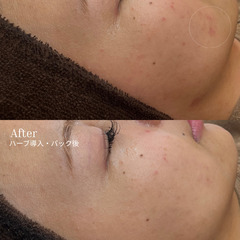 赤み・肌荒れが気になる方へ｜剥離なしハーブ（那覇）