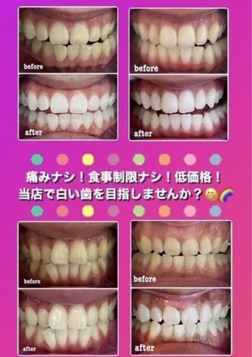 2名様のみご案内(残り1名様となりました！)??‍♂️1年間通い放題ホワイトニング?(最低保証付)