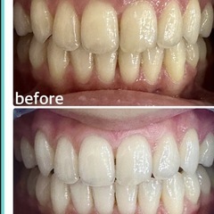 【沖縄市】ペア割プラン✨1組限定｜セルフホワイトニング20回×2人 70,000円→39,000円 (有効期限なし🔥)の画像