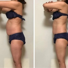 痩身ケア6️⃣回コースモニター募集🥰5名様限定❣️の画像