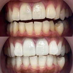 痩身ケア6️⃣回コースモニター募集🥰5名様限定❣️の画像