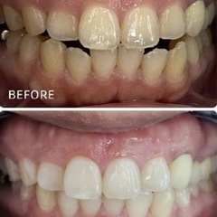 効果に自信あり‼️セルフホワイトニング🦷✨人気No.1チケット20回コース✌🏻の画像